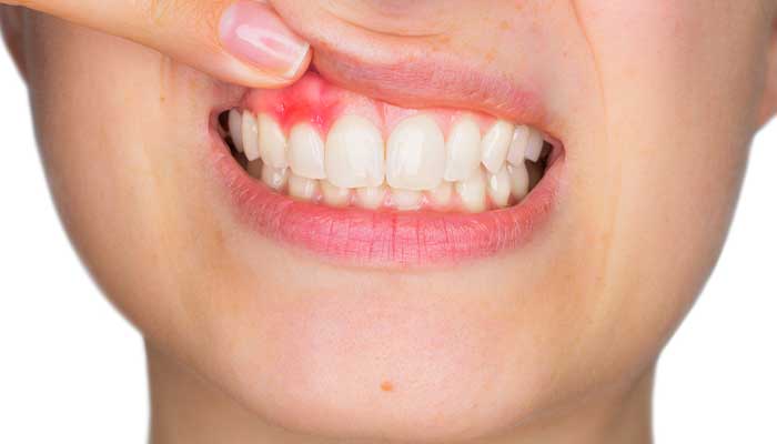 歯ぐきが下がる（痩せる）・歯周炎の悪化