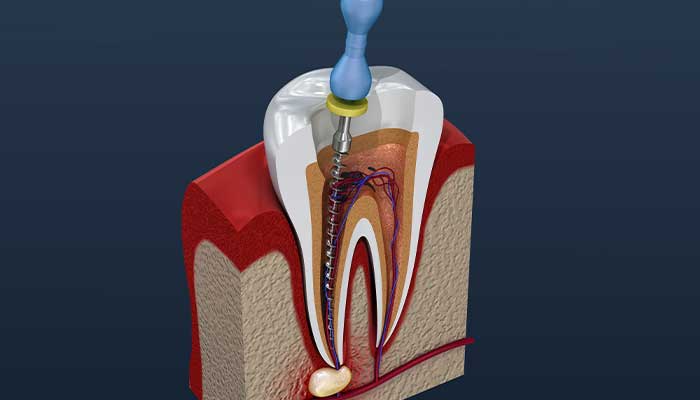 歯髄の除去と根管拡大、根管内の消毒