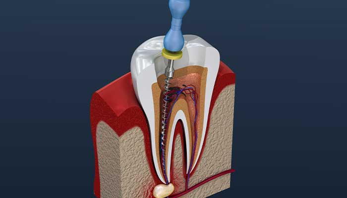 歯髄炎の治療法