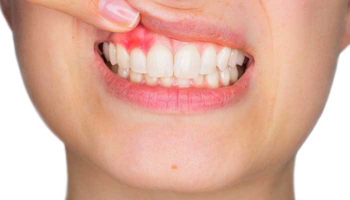 根尖性歯周炎の治療法